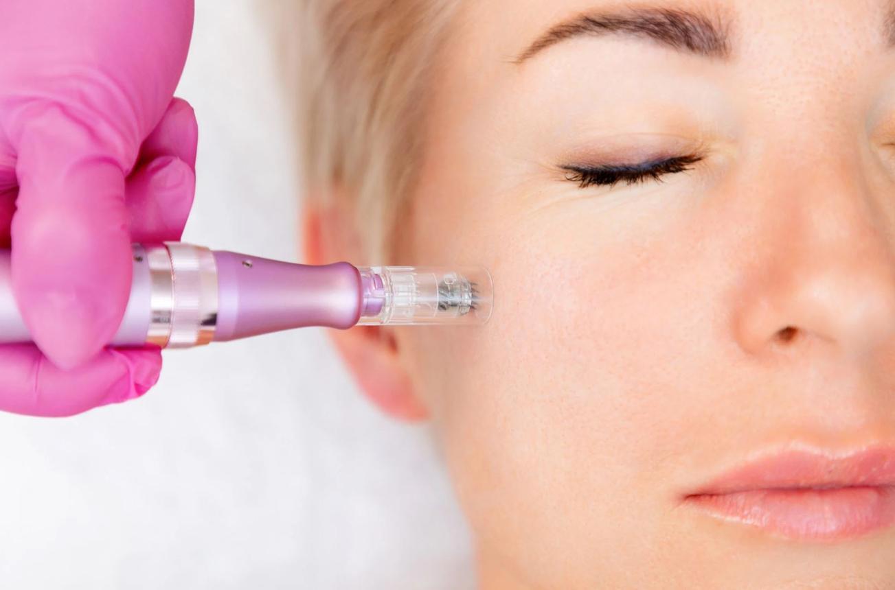 Microneedling vs Chemical Peels in Las Vegas | Acne, Scars & Glow